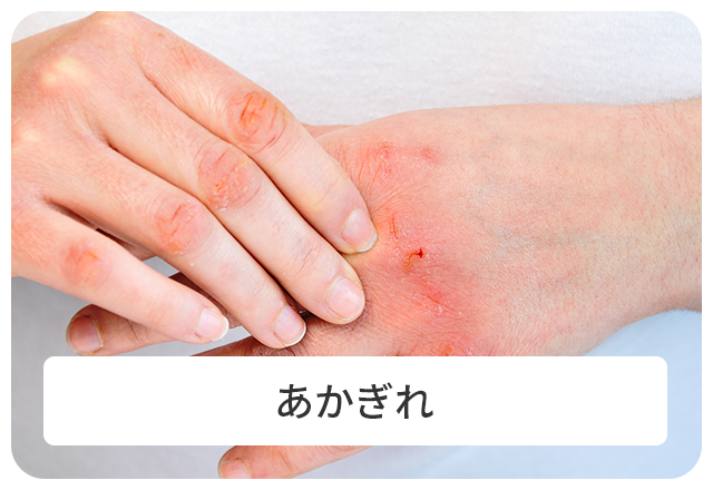 あかぎれ