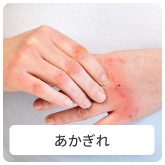 あかぎれ