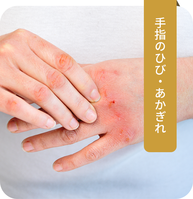 手指のひび・あかぎれ