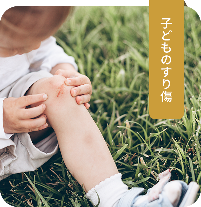 子どものすり傷